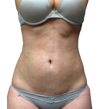 after vaser lipo