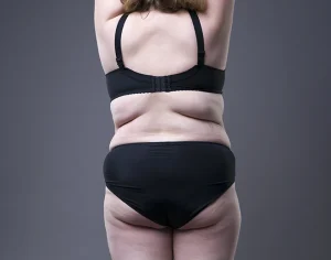Back Fat and Vaser liposuction