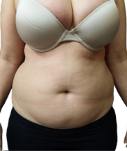before vaser lipo