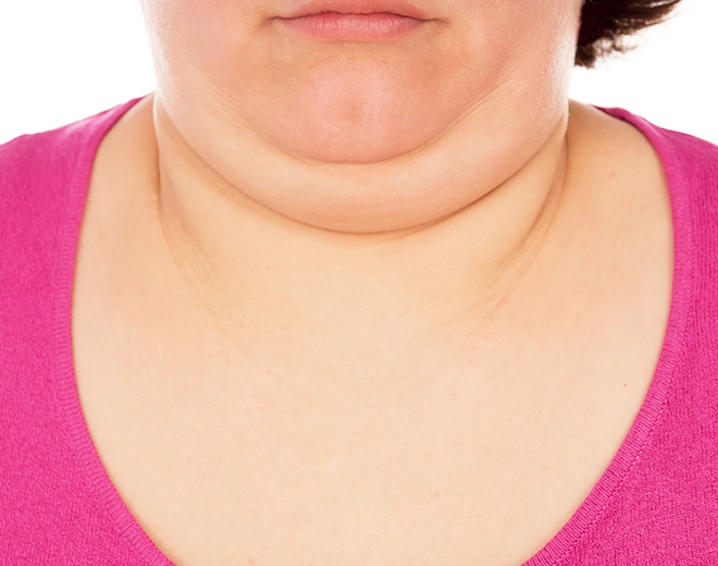 Close-up of woman with double chin before Vaser liposuction treatment