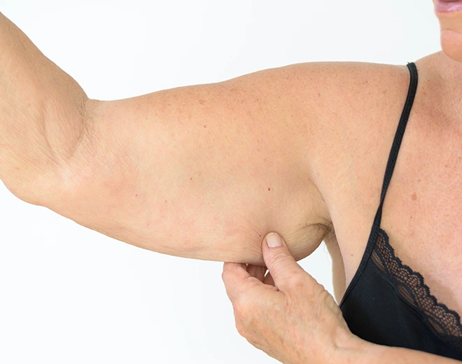 Woman showing loose skin on upper arm before arm liposuction