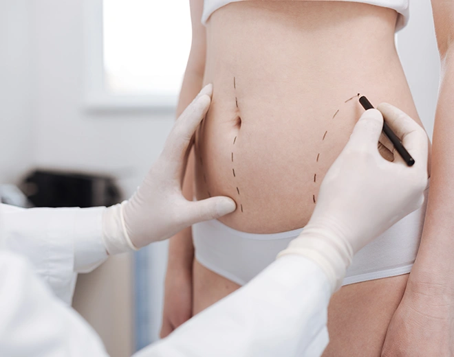 Surgeon’s gloved hands marking female abdomen with lines before Vaser liposuction procedure