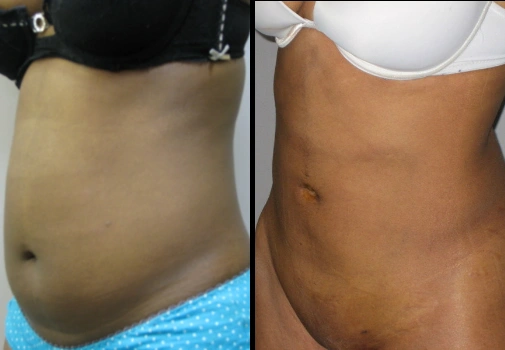 Vaser Lipo (Female)