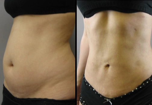 Vaser Lipo (Female)