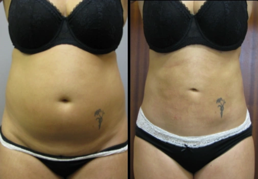 Vaser Lipo (Female)