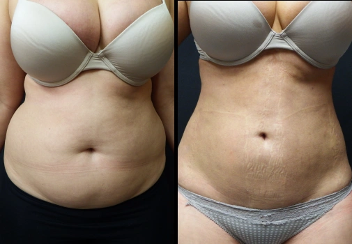 Vaser Lipo (Female)